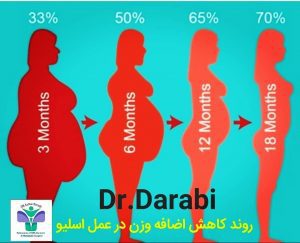 اسلیو معده