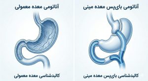آناتومی جراحی مینی بای پس معده