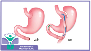 جراحی بای پس معده