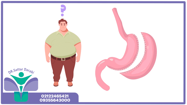 هزینه عمل اسلیو معده در تهران + شرایط ویژه و تضمینی