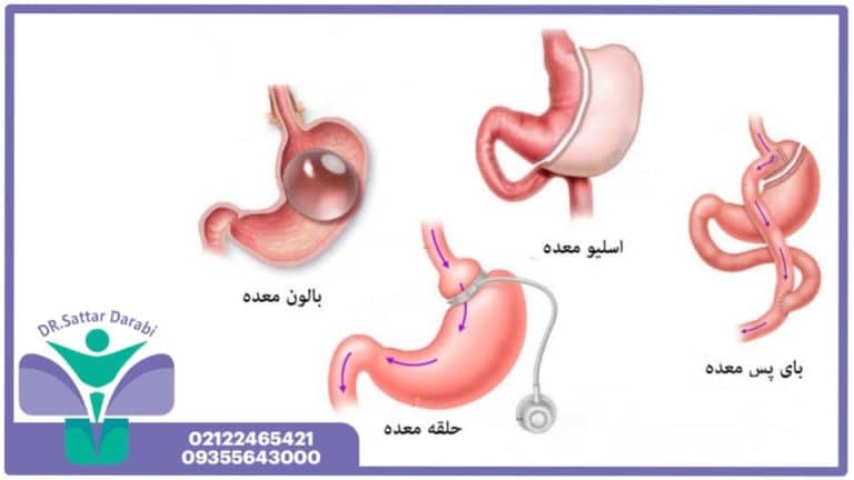 جراحی های چاقی
