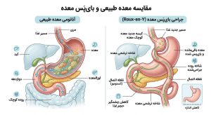 اینفوگرافی نحوه انجام بای پس معده
