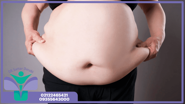بارداری و اسلیو معده