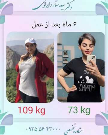اسلیو معده