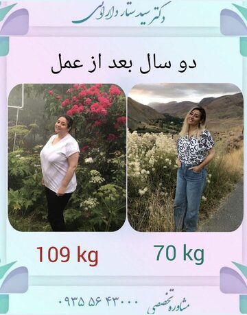 اسلیو معده