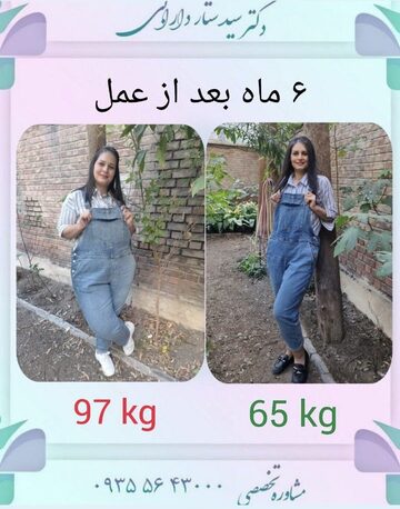 اسلیو معده