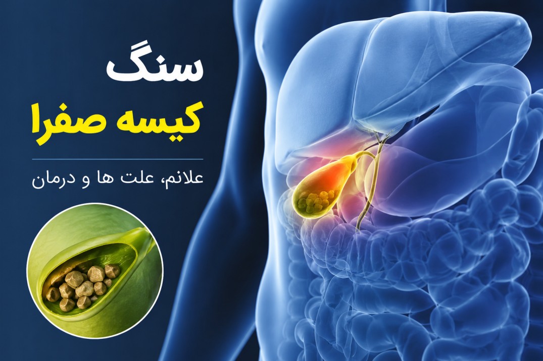 سنگ کیسه صفرا