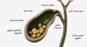 سنگ کیسه صفرا چیست