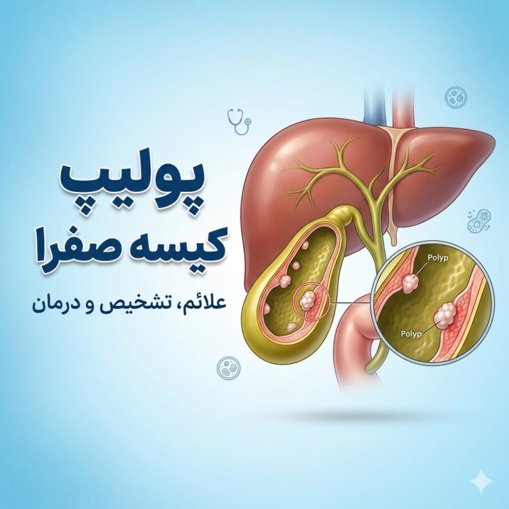 پولیپ کیسه صفرا