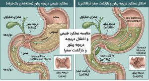 رفلاکس کیسه صفرا