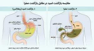 علت رفلاکس کیسه صفرا