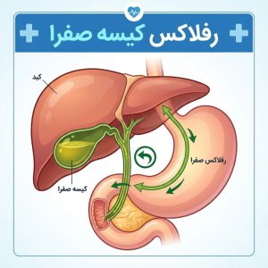 رفلاکس کیسه صفرا