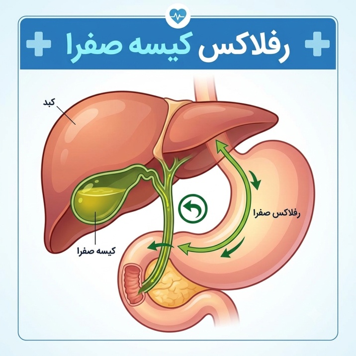 رفلاکس کیسه صفرا