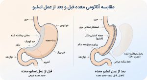 BMI مناسب برای اسلیو معده چقدره