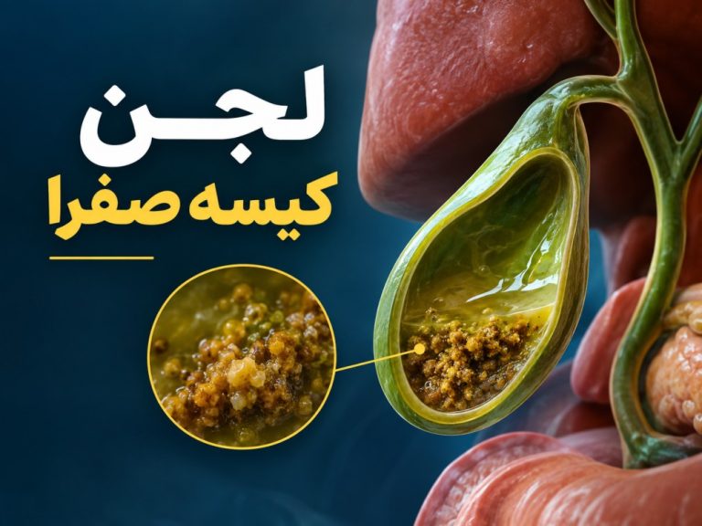 لجن کیسه صفرا