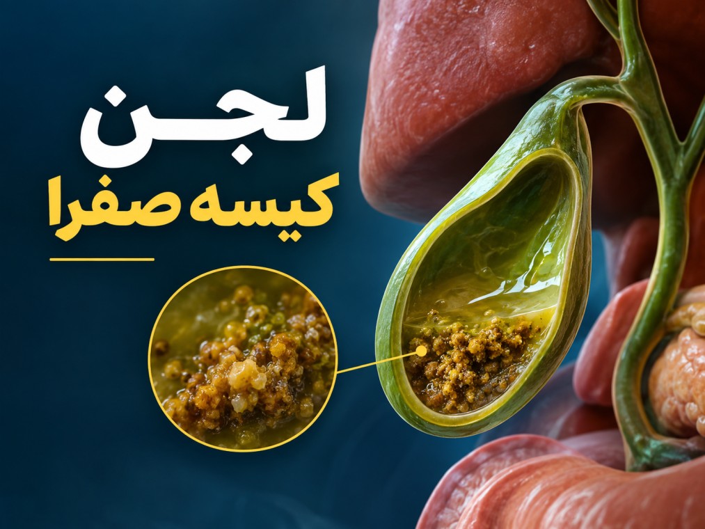 لجن کیسه صفرا
