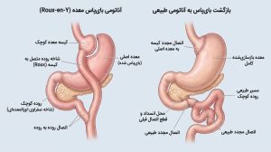 برگرداندن بای پس معده